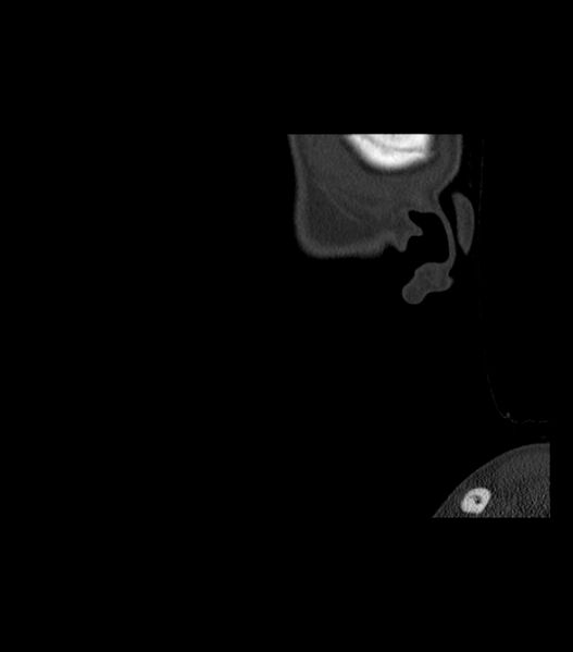 File:Nasoorbitoethmoid fracture (Radiopaedia 90044-107205 Sagittal bone window 139).jpg