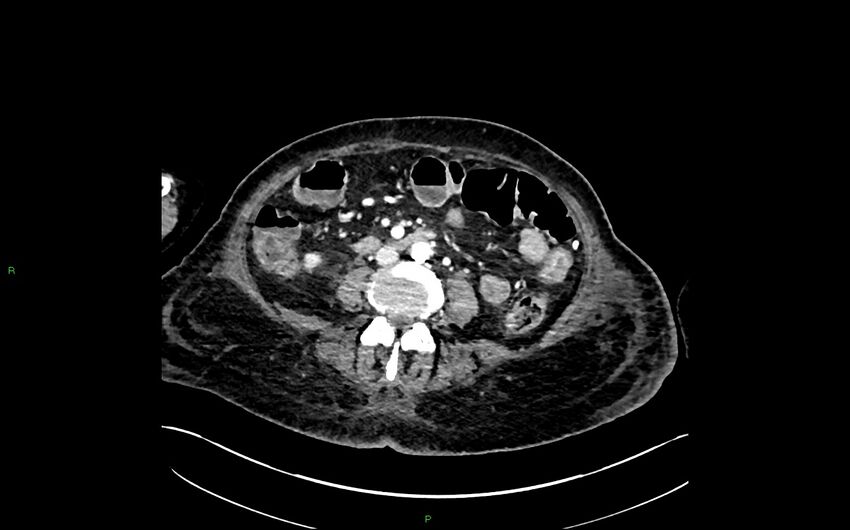 Neo-terminal ileal stricture (Crohn disease) (Radiopaedia 33790-34948 A 236).jpg