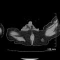 Neonatal neuroblastoma (Radiopaedia 56651-63438 Axial non-contrast 94).jpg