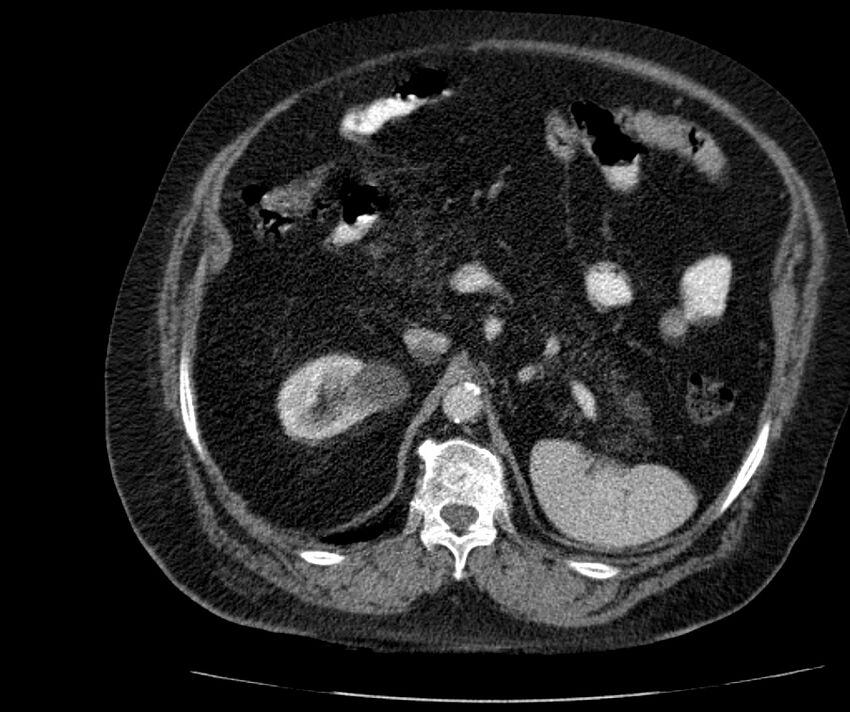 Nephroptosis with inguinal hernia containing perirenal fat (Radiopaedia 56632-63391 C 118).jpg