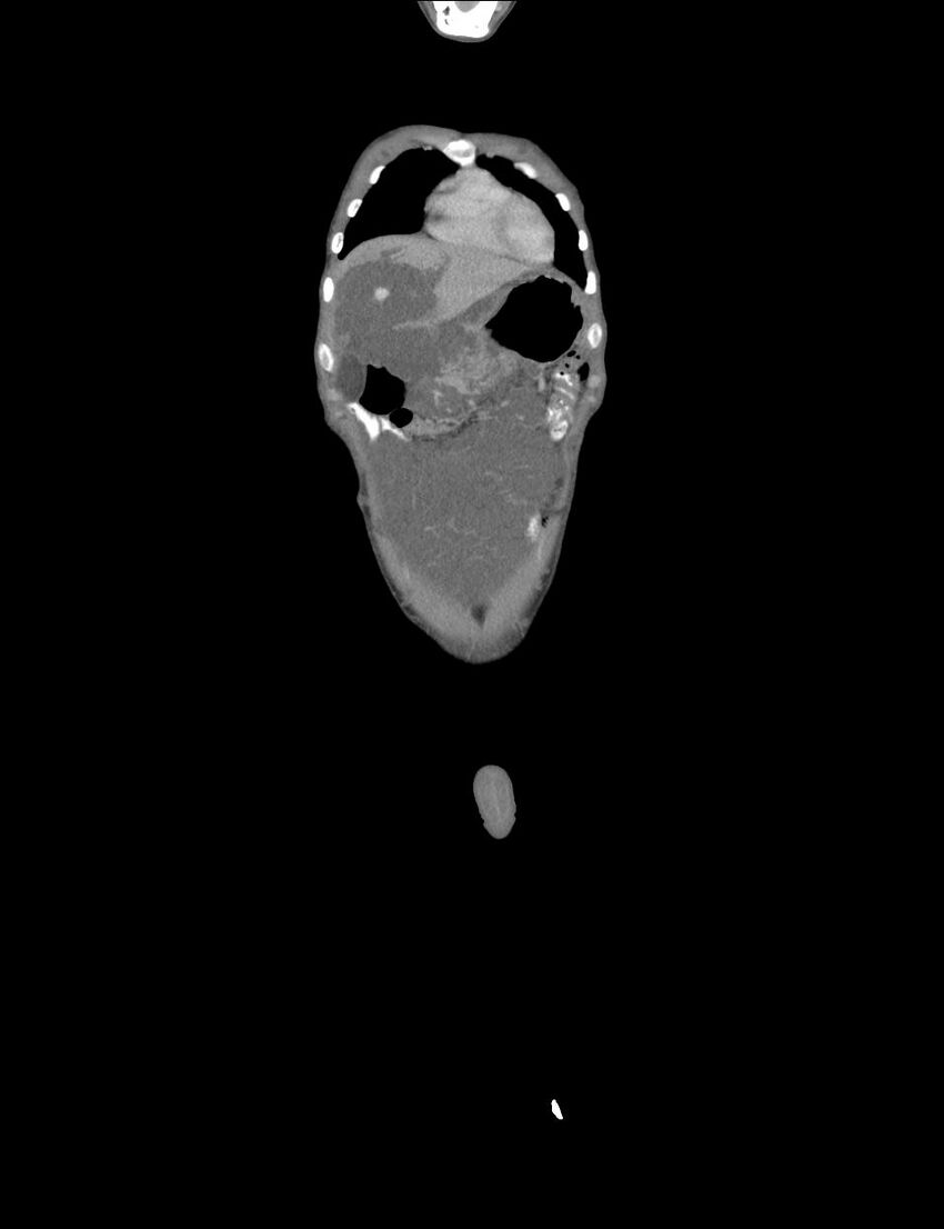Neurofibromatosis type 1 (Radiopaedia 49538-54733 B 44).jpg