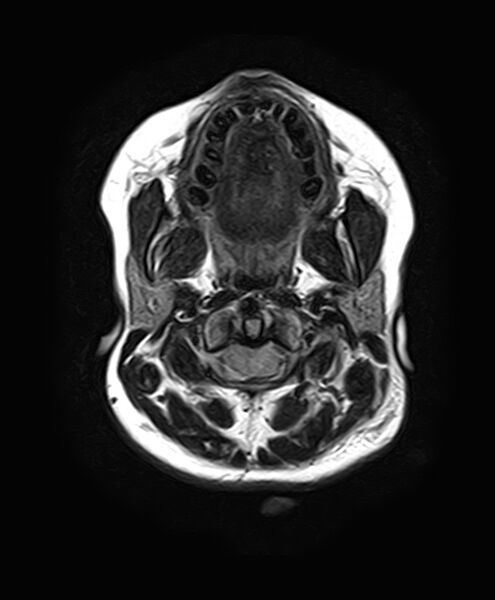 File:Neurofibromatosis type 2 (Radiopaedia 66211-75401 Axial FLAIR 5).jpg
