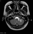 Neurofibromatosis type 2 - cranial and spinal involvement (Radiopaedia 5351-7111 Axial T2 1).jpg