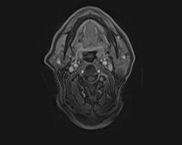 File:Non-Hodgkin lymphoma - parotid gland (Radiopaedia 71531-81890 E 7).jpg