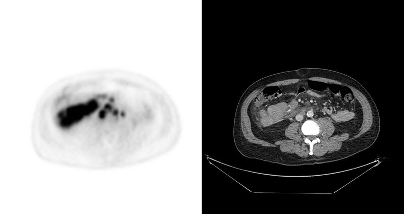 File:Non-Hodgkin lymphoma involving seminal vesicles with development of interstitial pneumonitis during Rituximab therapy (Radiopaedia 32703-33675 axial PET CT 24).jpg