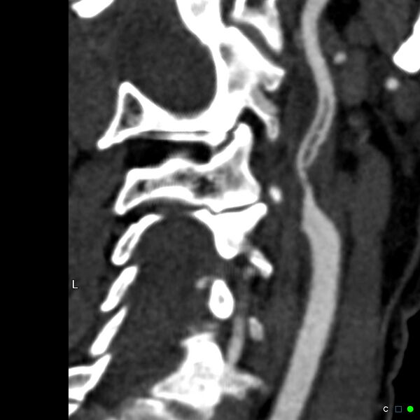 File:Non-occlusive intraluminal internal carotid artery thrombus (Radiopaedia 37751-39658 A 29).jpg
