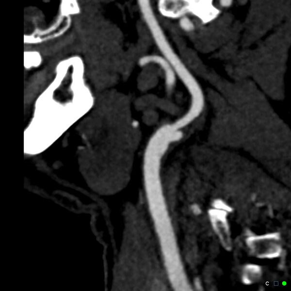 File:Non-occlusive intraluminal internal carotid artery thrombus (Radiopaedia 37751-39658 C 55).jpg