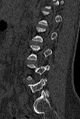 Normal CT lumbar spine (Radiopaedia 53981-60118 Sagittal bone window 68).jpg