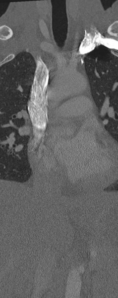 File:Normal CT thoracic spine (Radiopaedia 40181-42688 Coronal bone window 4).png