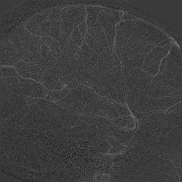 File:Normal cerebral angiogram (four vessel DSA) (Radiopaedia 41708-44649 F 16).png