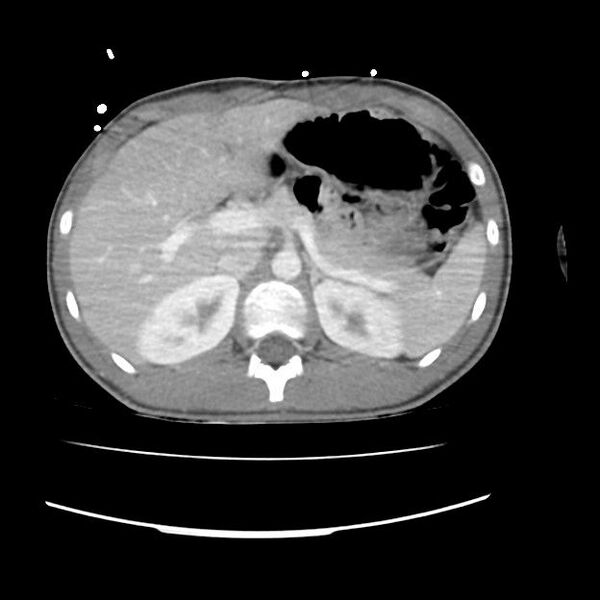 File:Normal dual-phase trauma CT chest,abdomen and pelvis (Radiopaedia 48092-52899 A 57).jpg