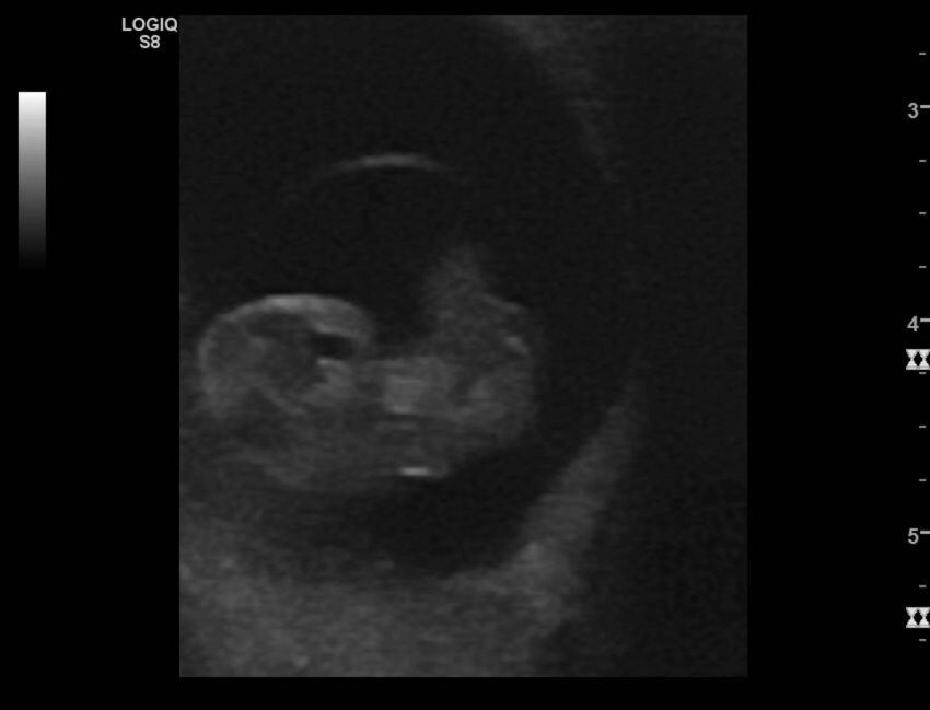 Normal early pregnancy - 8w0d (Radiopaedia 44715-48492 Longitudinal 61).jpg