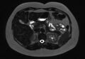 Normal liver MRI with Gadolinium (Radiopaedia 58913-66163 E 19).jpg