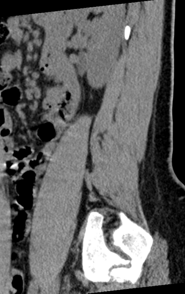 File:Normal lumbar spine CT (Radiopaedia 46533-50986 C 18).png