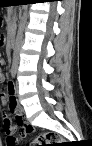File:Normal lumbar spine CT (Radiopaedia 46533-50986 C 48).png