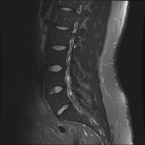 File:Normal lumbar spine MRI (Radiopaedia 43051-46311 Sagittal STIR 13).jpg