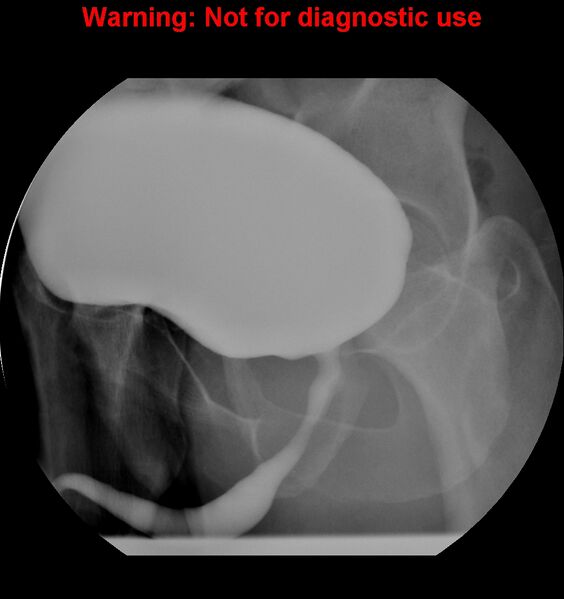 File:Normal retrograde urethrogram (RUG) and voiding cystourethrogram (VCUG) (Radiopaedia 40478-43050 VCUG 6).jpg