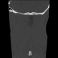 Normal trauma cervical spine (Radiopaedia 41017-43760 Coronal bone window 45).png