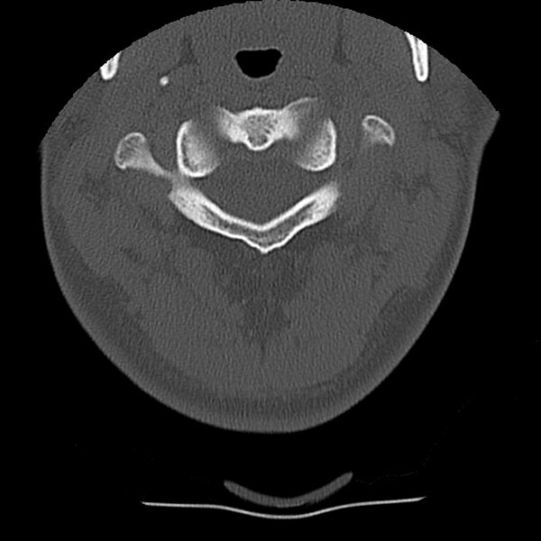 File:Normal trauma spine imaging (Radiopaedia 31753-32686 Axial bone window 13).jpg