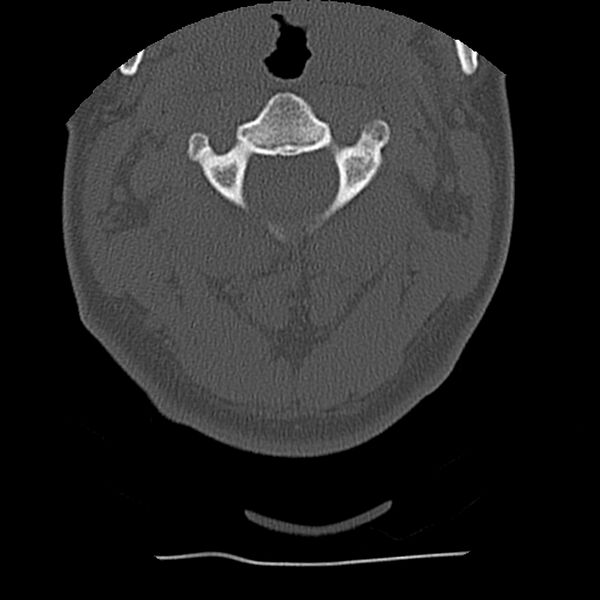 File:Normal trauma spine imaging (Radiopaedia 31753-32686 Axial bone window 20).jpg