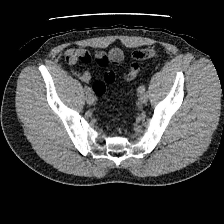 Obstructing ureteric calculus and ureteric anatomy (Radiopaedia 62730-71042 Axial non-contrast 133).jpg