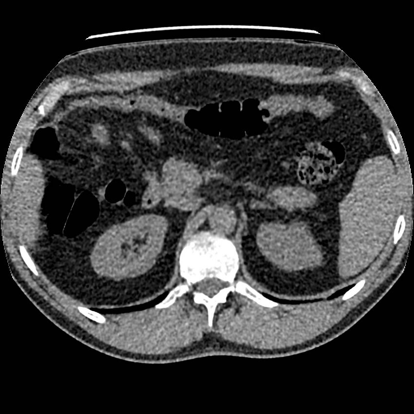 Obstructing ureteric calculus and ureteric anatomy (Radiopaedia 62730-71042 Axial non-contrast 19).jpg