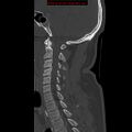 Occipital condyle fracture (Radiopaedia 18366-18208 Sagittal bone window 21).jpg