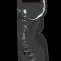 Occipital condyle fracture (Radiopaedia 18366-18208 Sagittal bone window 4).jpg