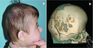 a)Significant turribrachycephaly b) sagittal, lambdoid,squamosal sutures with large fontanelle