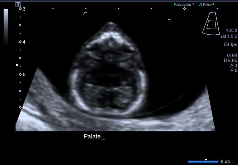 File:1st trimester nuchal-morphology ultrasound (Radiopaedia 44706-48477 General anatomy and NT 9).jpg