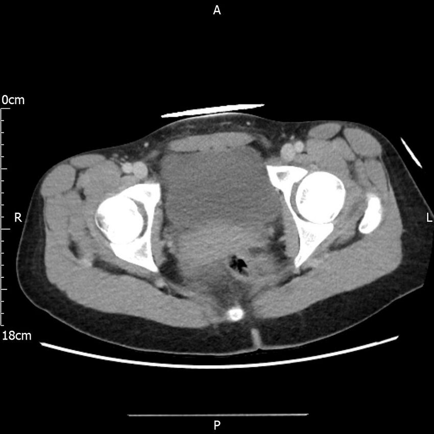 AAST grade IV kidney injury with CEUS follow-up (Radiopaedia 72353-82877 Axial C+ portal venous phase 74).jpg
