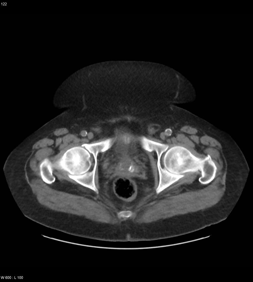Abdominal aortic aneurysm with intramural hematoma then rupture (Radiopaedia 50278-55631 Axial non-contrast 118).jpg