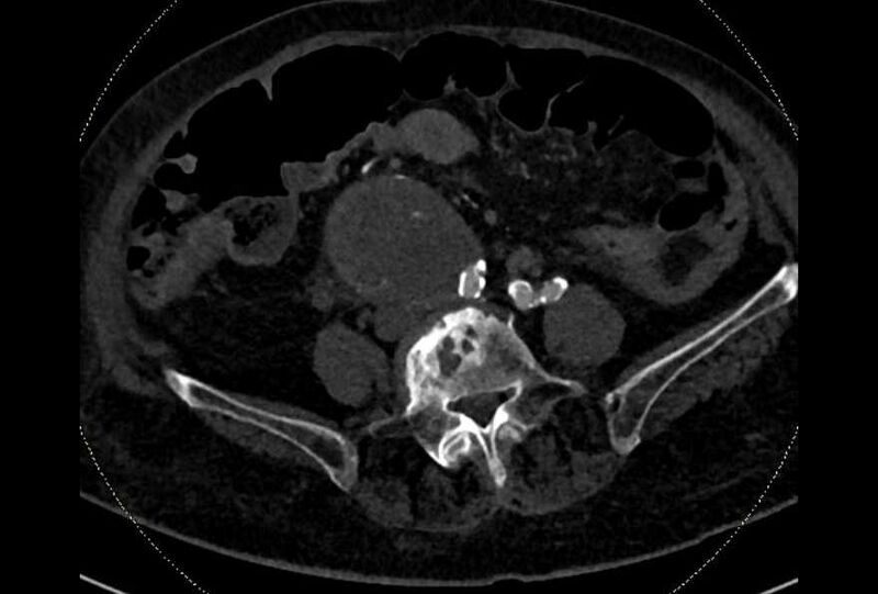 File:Abdominal aortic aneurysm with thrombus fissuration (Radiopaedia 73192-83919 Axial C+ arterial phase 141).jpg