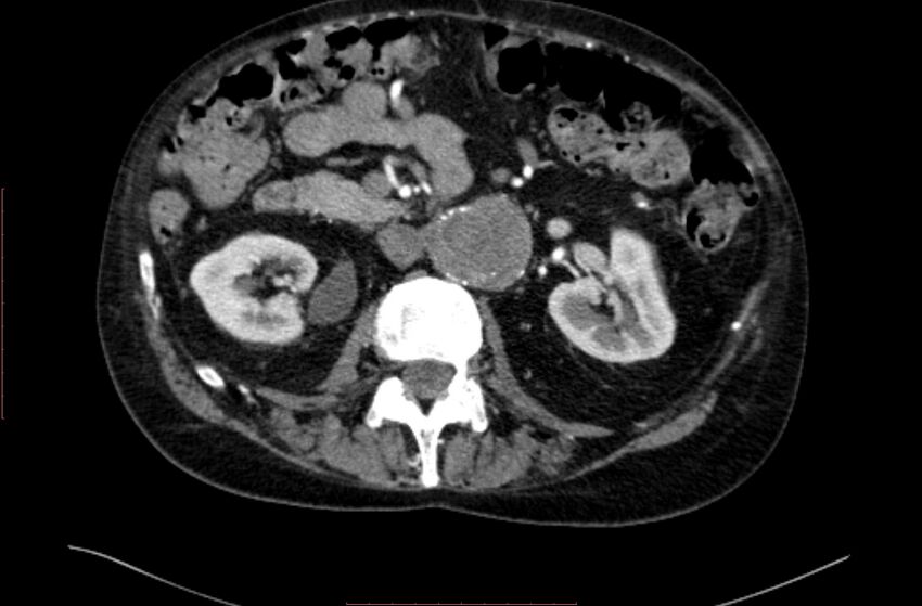 Abdominal aortic interposition tube graft and aneurysm thrombosis (Radiopaedia 71438-81857 Axial C+ arterial phase 59).jpg
