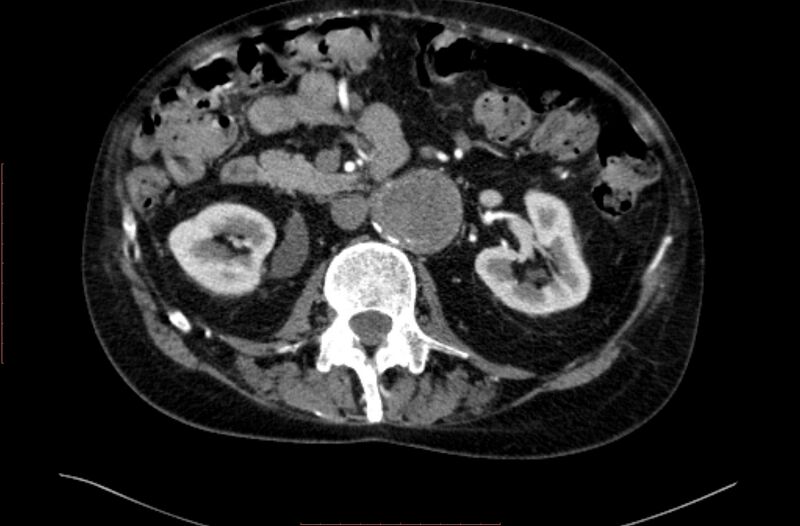 File:Abdominal aortic interposition tube graft and aneurysm thrombosis (Radiopaedia 71438-81857 Axial C+ arterial phase 62).jpg