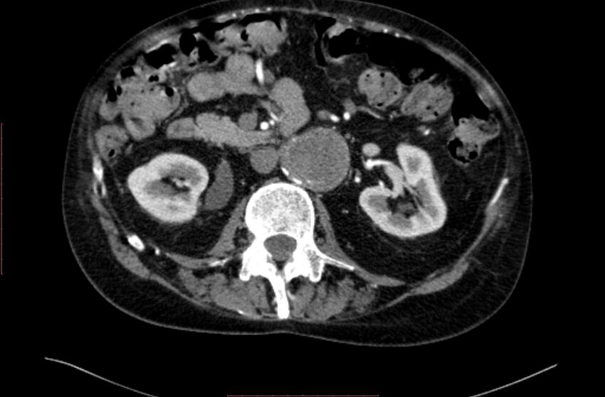 Abdominal aortic interposition tube graft and aneurysm thrombosis (Radiopaedia 71438-81857 Axial C+ arterial phase 62).jpg