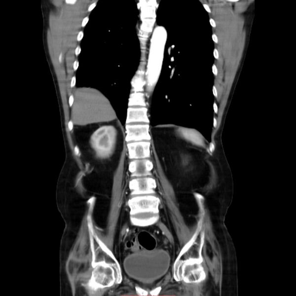 File:Abdominal aortic interposition tube graft and aneurysm thrombosis (Radiopaedia 71438-81857 Coronal C+ arterial phase 19).jpg