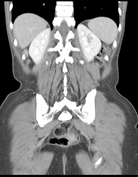 File:Abdominal desmoid tumor (Radiopaedia 41007-43740 Coronal C+ portal venous phase 32).png
