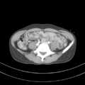 Abdominal multi-trauma - devascularised kidney and liver, spleen and pancreatic lacerations (Radiopaedia 34984-36486 Axial C+ portal venous phase 54).png