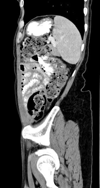 File:Abdominal wall and retroperitoneal tuberculosis (Radiopaedia 88137-104729 Sagittal C+ portal venous phase 33).jpg