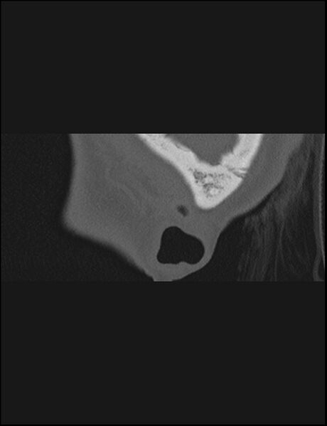 File:Aberrant right internal carotid artery (Radiopaedia 65191-74198 Sagittal non-contrast 5).jpg