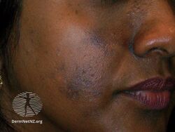 Acne in a person with dark skin