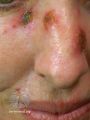 Actinic Keratoses treated with imiquimod (DermNet NZ lesions-ak-imiquimod-3760).jpg
