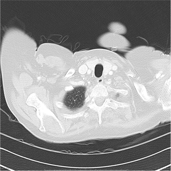 File:Acute-on-chronic pulmonary emboli (Radiopaedia 27925-28169 lung window 1).jpg