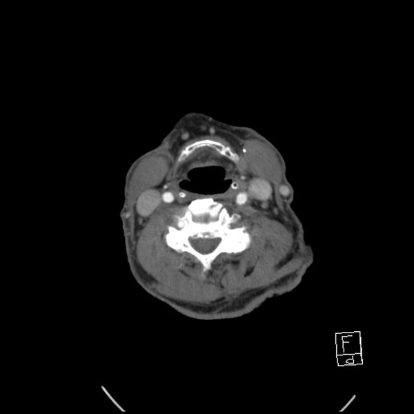File:Acute ICA ischemic penumbra due to high-grade CCA stenosis (CT perfusion) (Radiopaedia 72038-82530 Axial C+ arterial phase 49).jpg