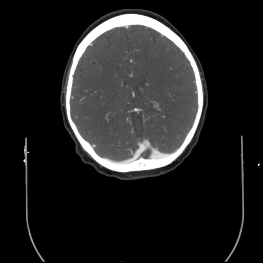 Acute M1 occlusion with ischemic penumbra (CT perfusion) (Radiopaedia 71897-82344 Axial C+ arterial phase thins 33).jpg