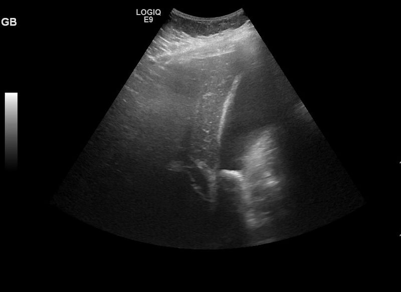 File:Acute cholecystitis with gallbladder neck calculus (Radiopaedia 42795-45969 Transverse 6).jpg