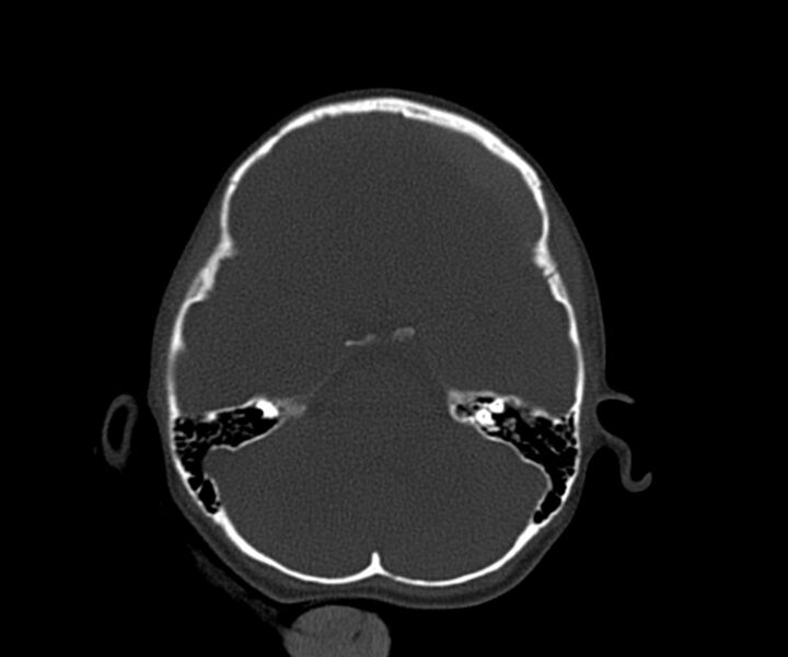 File:Acute epidural hematoma (Radiopaedia 63659-72335 Axial bone window 8).jpg