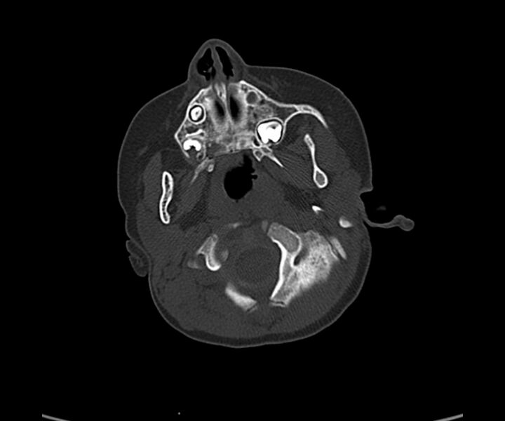 File:Acute hemorrhagic contusion (Radiopaedia 63660-72336 Axial bone window 8).jpg