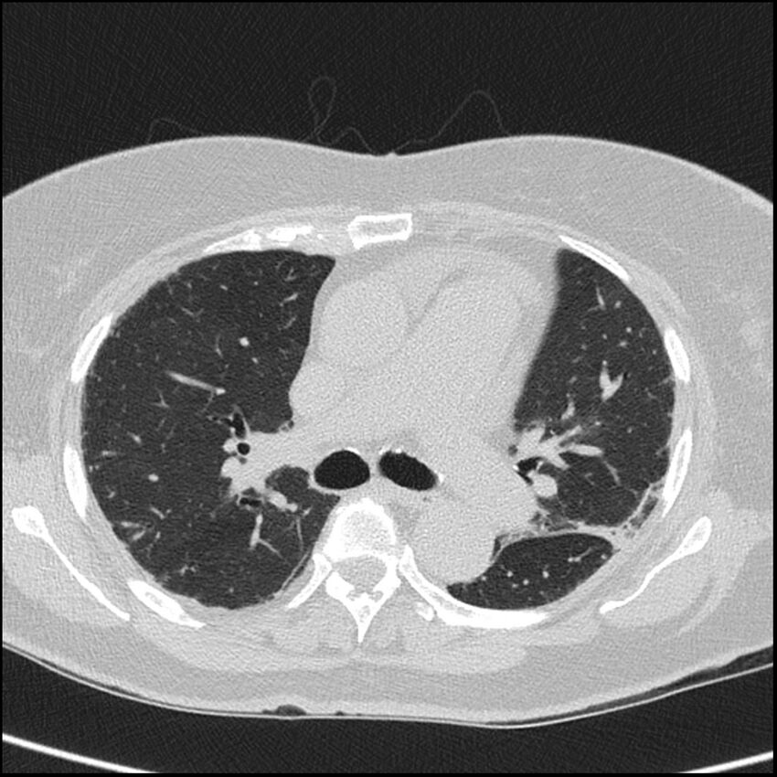 Acute interstitial pneumonitis (Radiopaedia 45404-49453 Axial lung window 36).jpg
